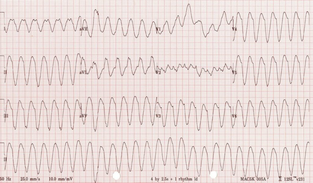 life in the fast lane ecg